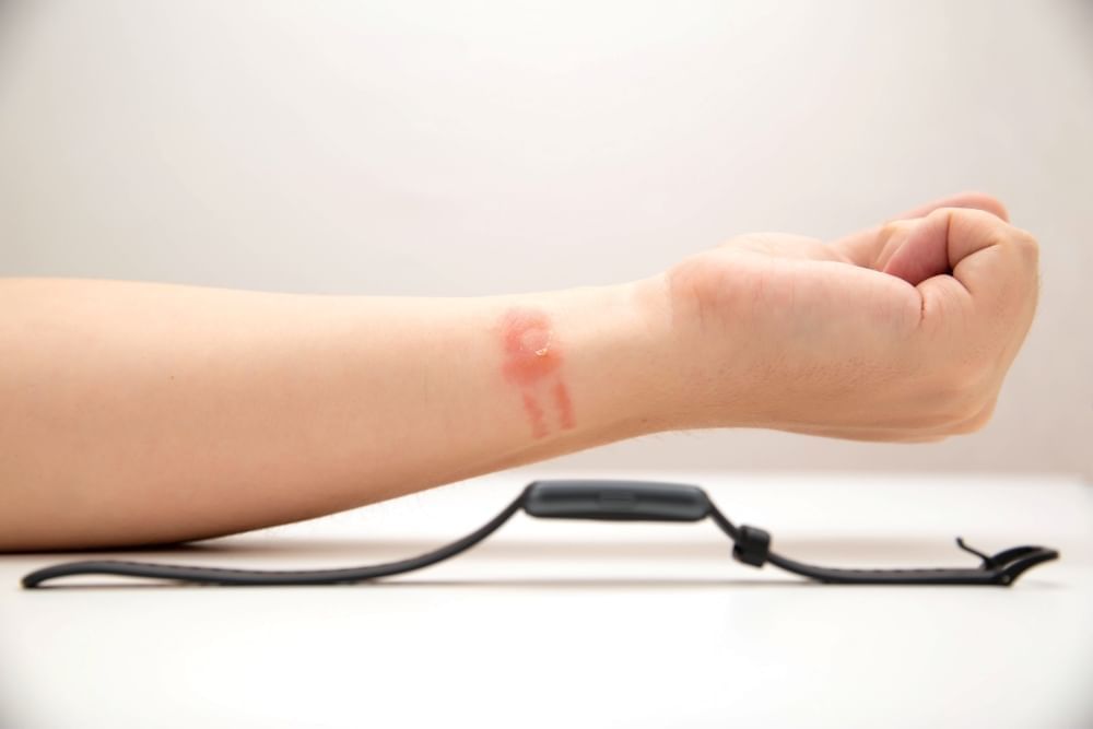 An outstretched arm with a red rash around the wrist laying on a table beside a watch. 