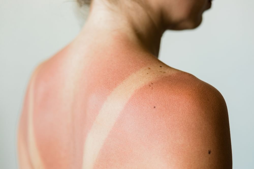 A close-up of a woman's back and shoulders with prominent sun burn lines. 