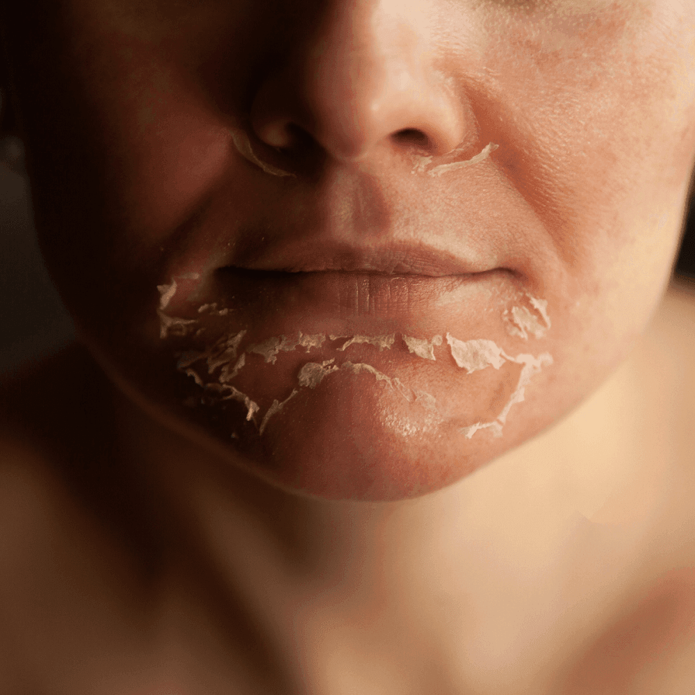 Close-up of peeling facial skin around the lips and chin under warm light during a skincare treatment at Hotel X Toronto