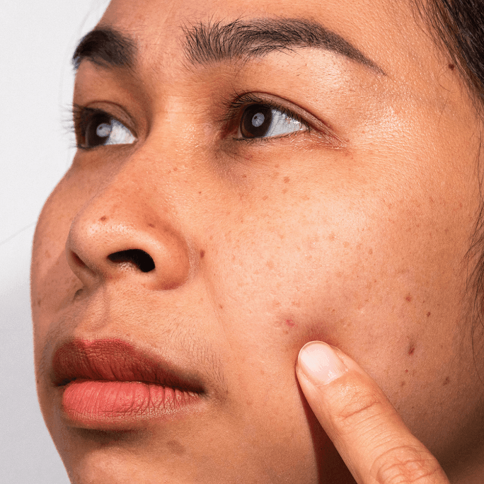 Guest pointing to facial blemishes on her cheek under soft glow during a skincare consultation in spa at Hotel X Toronto